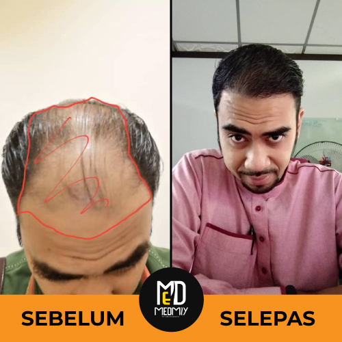 SEBELUM-VS-SELEPAS-4