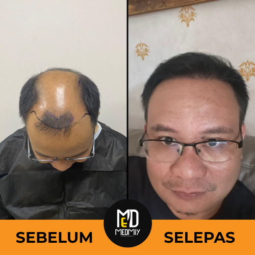 SEBELUM-VS-SELEPAS-6
